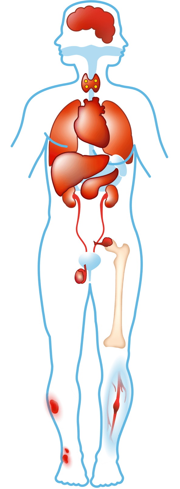 Complications of transfusion-dependent thalassemia (TDT)