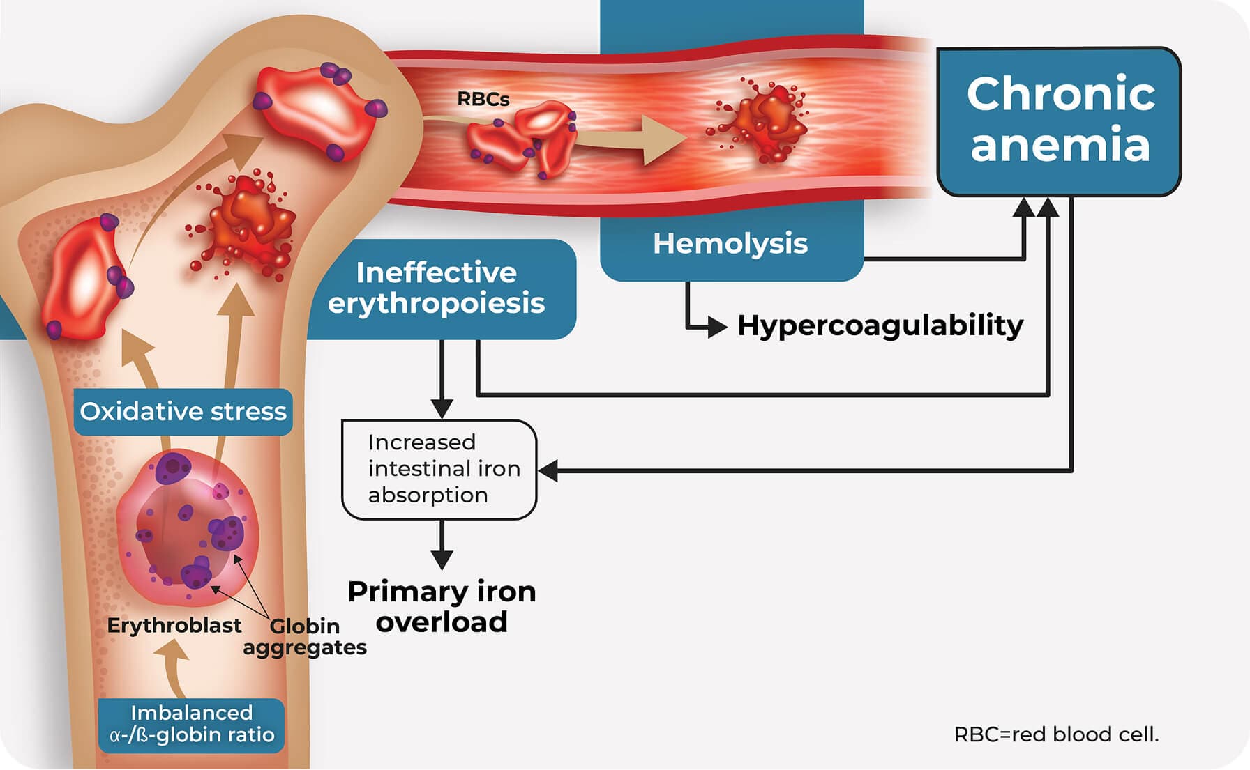 Depiction of thalassemia pathophysiology, which includes disrupted red blood cell production (ineffective erythropoiesis) and increased destruction (hemolysis), causing anemia.